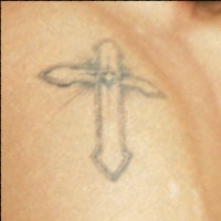 Located on Nicholas's right shoulder